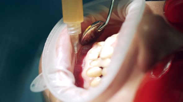 Close Up of Anesthetic Getting Injected Into Patient's Gums alt