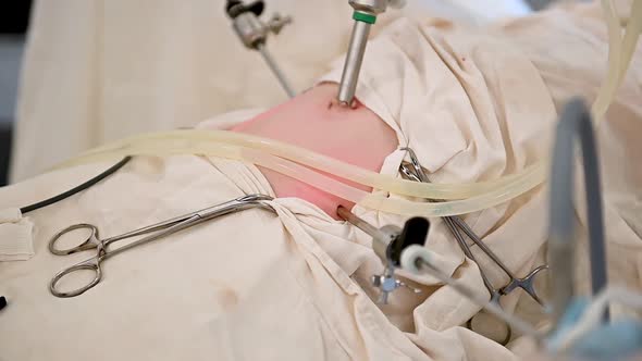 An Assistant Assists the Surgeon with the Operation Laparoscopic Appendectomy alt