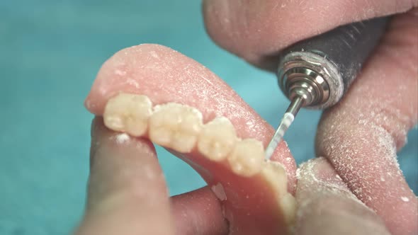 Dentist Makes a Dental Implant Prosthesis Made of Plaster Cast alt