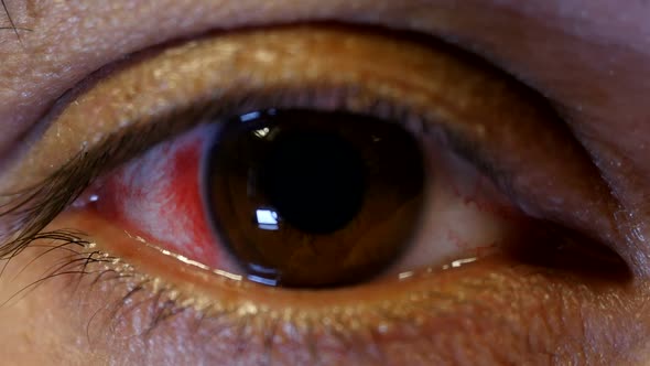 Open Eye With Blood Red Vessels