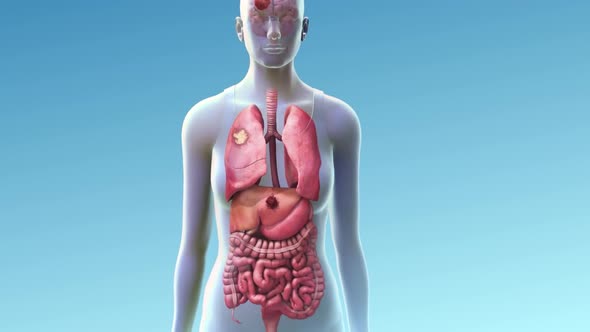 Metastatic lung cancer starts in the lungs and spreads to other areas alt