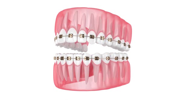 Jaw with teeth and golden orthodontic braces  isolated over white background