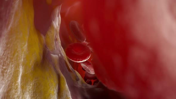 Cholesterol Plaque in an Artery