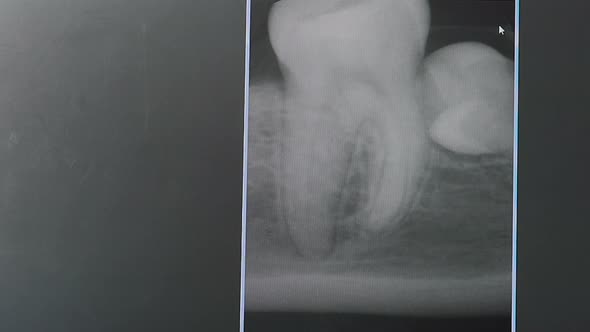 Dentist Discussing with Patient Bad Teeth Xray Pointing with Finger alt
