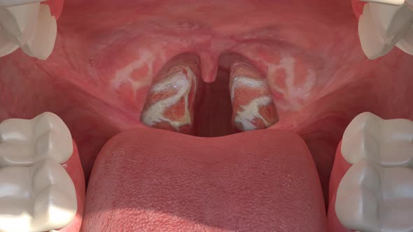 3 D Tonsillitis alt