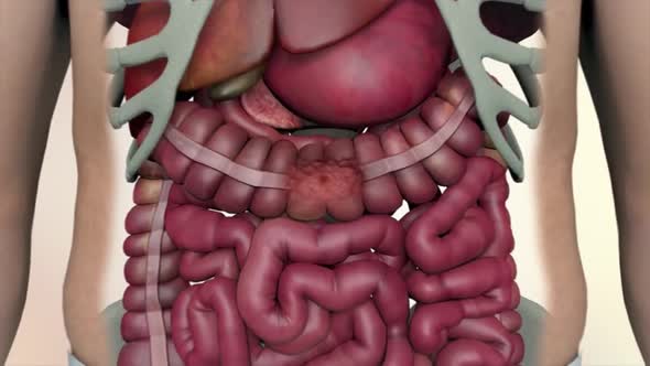 Colon during a enteroscopy with a intestinal or bowel cancer tumor visible. alt