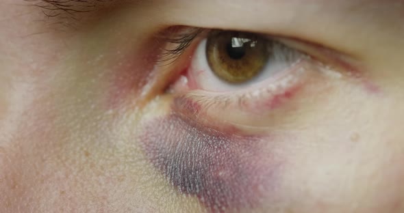 The Eye of a Man with a Bruise and Abrasions alt