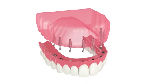 Removable snap-on full implant denture installation