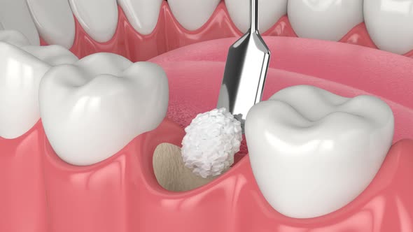dental bone grafting and bone augmentation procedure
