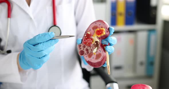 Doctor Urologist and Nephrologist Holds Kidney Model alt