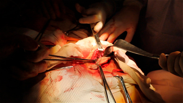 Specialized Team Performing Surgery In Operating