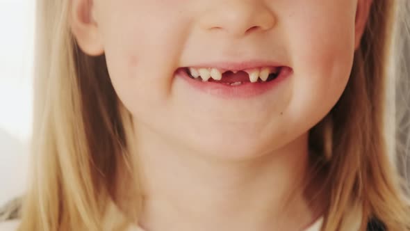 Close-up mouth child has lost two milk teeth. Replacement of permanent changing teeth, toothless alt