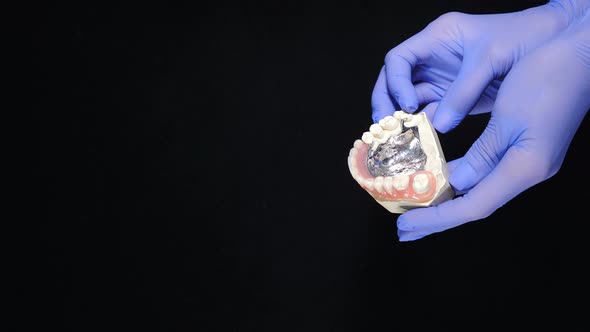 Female Hands in Blue Gloves Holding Jaw Model with Dental Bridging and Crowns Sample alt