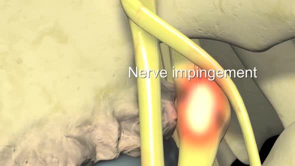 disc nerve impingement.mov alt