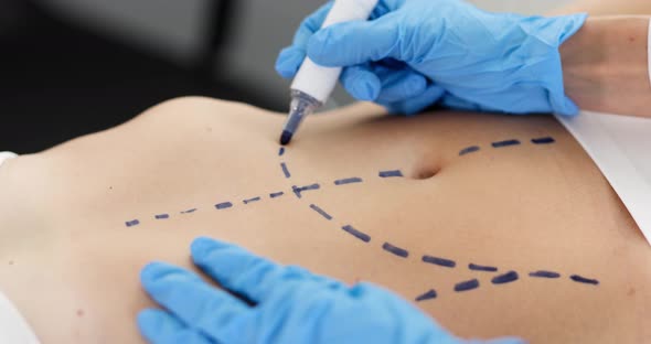 Doctor Plastic Surgeon Drawing Preoperative Markings on Skin of Patient Abdomen  Movie alt