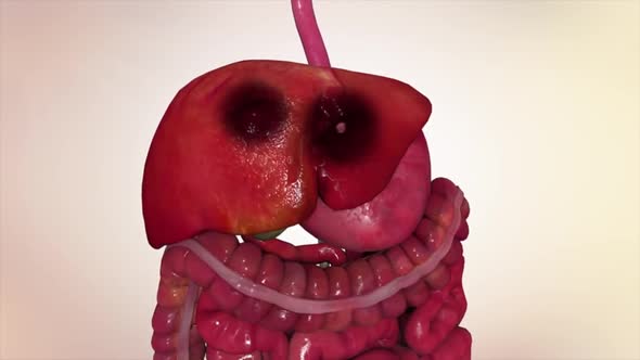 liver cancer 3d medical anatomy, Motion Graphics | VideoHive