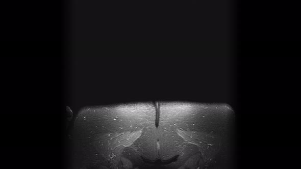 Postoperative MRI of Female Organs for the Detection of Metastases alt