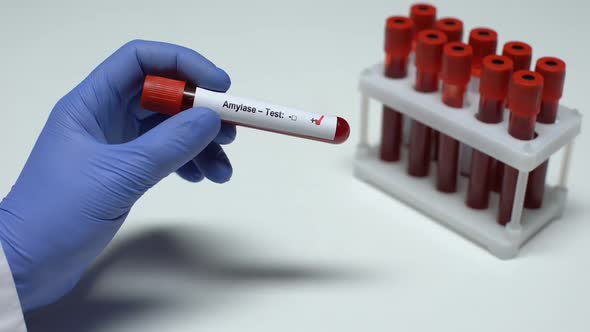 Positive Amylase Test, Doctor Showing Blood Sample, Lab Research, Health Checkup alt