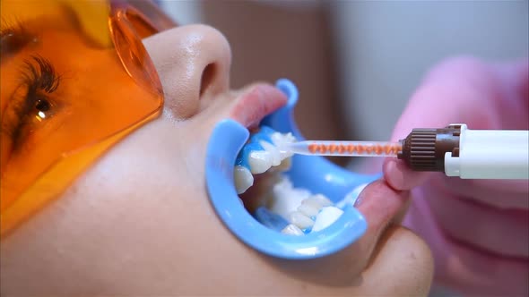 Dentist Prepares Patient For Teeth Whitening Procedure Woman Patient In Dental Clinic.