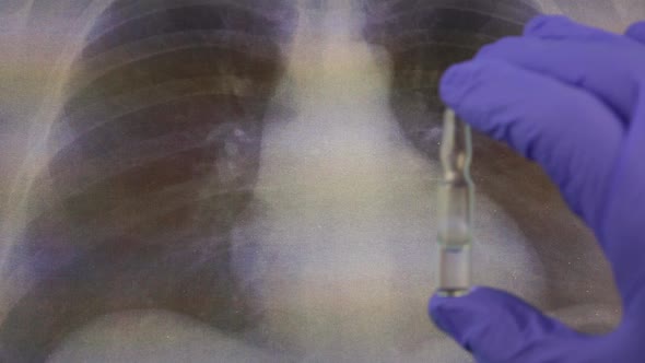 X-ray of the Lungs and Vaccine
