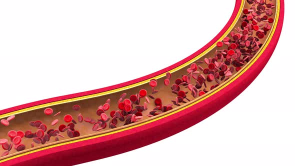 3D rendered Animation of a clogged Artery developing Arteriosclerosis