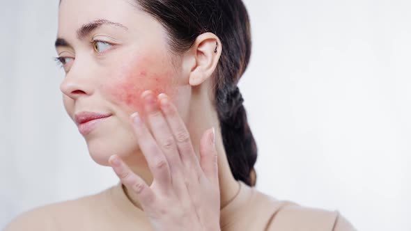 Young beautiful woman touching the redness on her cheek with her fingers and looking at the side alt