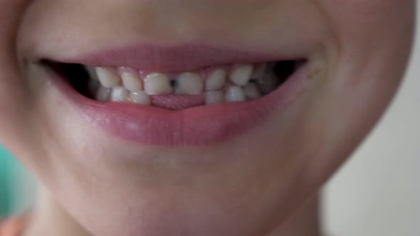 Close Up Little Child Show Broken Teeth Boy with a Teeth Broken and ...