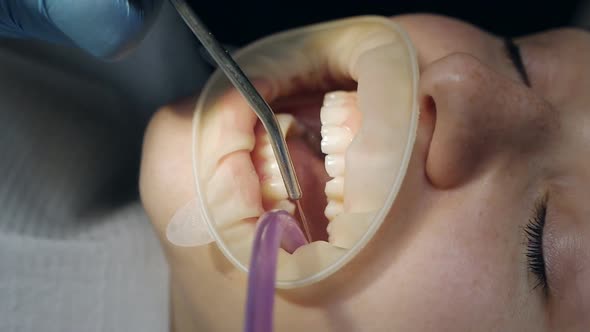 Young Woman with a Retractor in Her Mouth in a Dental Clinic