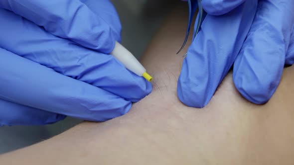 Modern Hair Removal Treatment By Electrolysis Beautician is Removing Hair From Underarm alt