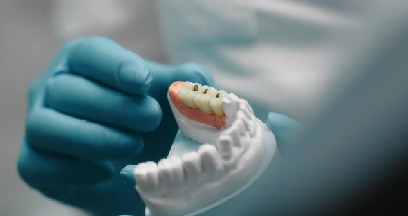 Hands of Dentist Place Dental Implant in Plaster Model of Teeth
