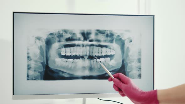 The Dentist Examines a Panoramic Xray of the Teeth alt
