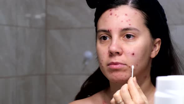 Woman Face Covered with Red Acne Chickenpox Disease alt