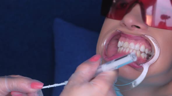 Dentist Applying Gel for LED Whitening To Woman Patient's Teeth in Dentistry