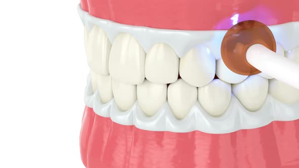Professional teeth whitening by lamp over white background