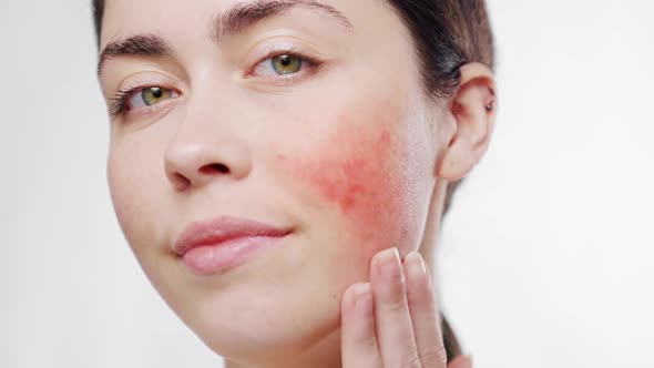 Close-up face of a young beautiful woman touching the inflammation rosacea on her cheek alt