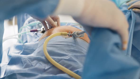 Close Up of Hands of Surgeons Team During Operation Uterus Removal with Surgical alt