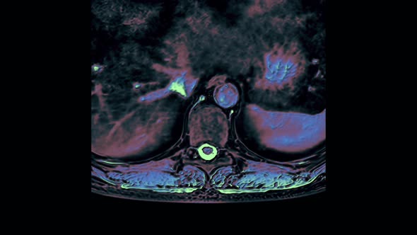 Color MRI of the Thoracic Region, Detection of Protrusions and Hernias on the Spine