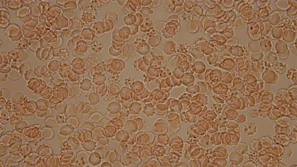 Blood Under a Microscope, the Movement of Spur-shaped Red Blood Cells, Which Indicates a Human alt