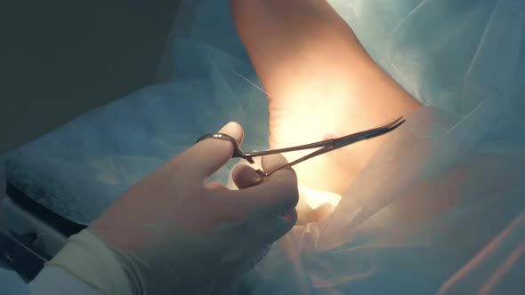 Surgeon Sutures Ankle During Surgery with Neat Stitches After Removing Hygroma