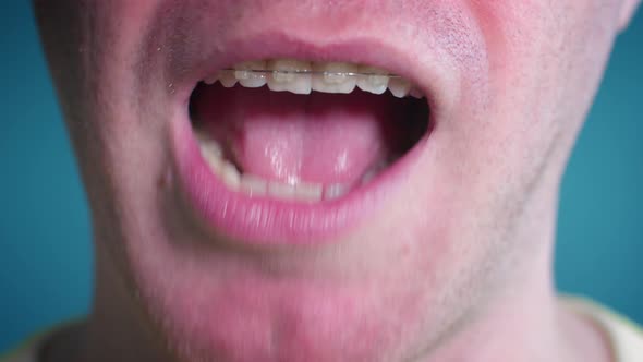 Close Up Mouth of Angry Man Smile with Dental Braces Close Up, Stock ...