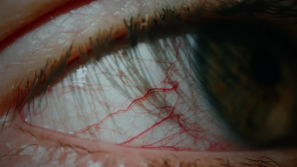 Conjunctivitis Red Eye alt