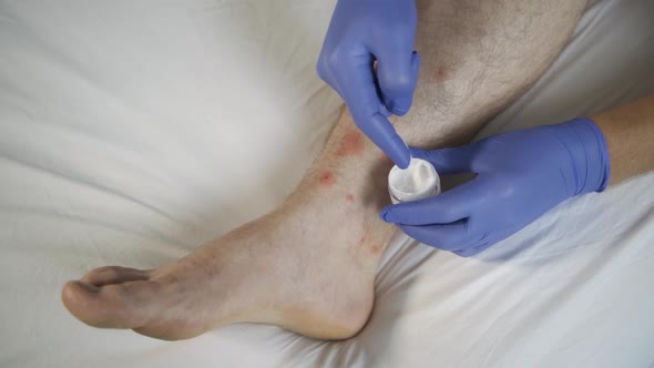 Dyshidrotic Eczema on the Foot Dermatitis