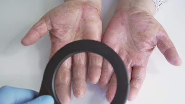 uses a magnifying glass to diagnose and examine Dermatitis sore skin