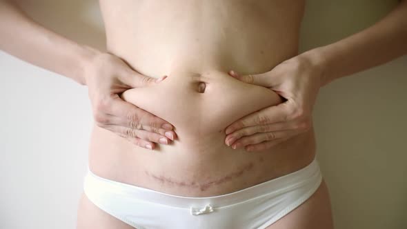 Woman Grabbing the Loose Skin on Stomach After Giving Birth By Caserean Section alt
