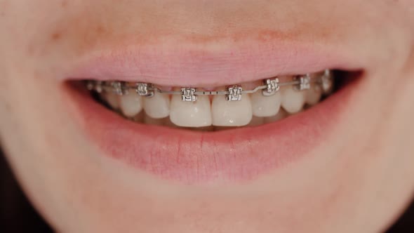 Female Smile with Dental Braces alt