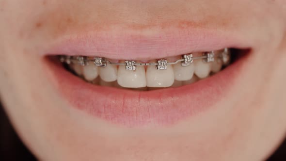 Female Smile with Dental Braces