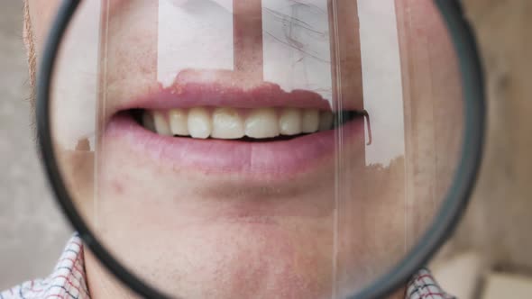 Male Teeth Through A Magnifying Glass, Dental Caries, Herpes On The Lip Of A Young Man. alt