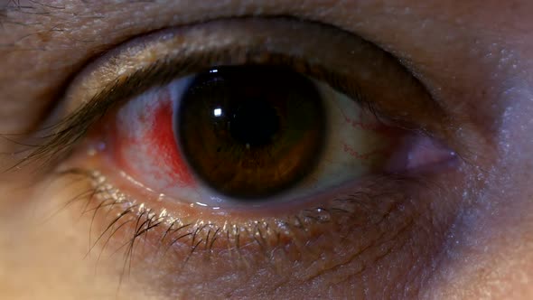 Open Sick Male Eye With Blood Vessels