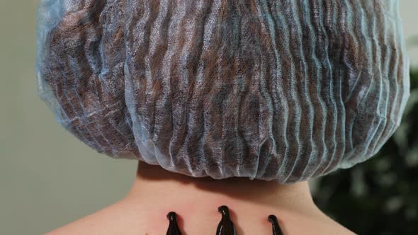 Three Leeches on Patient's Neck Closeup