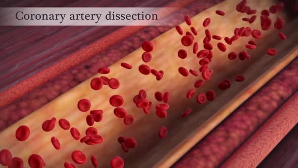 Coronary artery dissection occurs when a tear occurs in a blood vessel ...